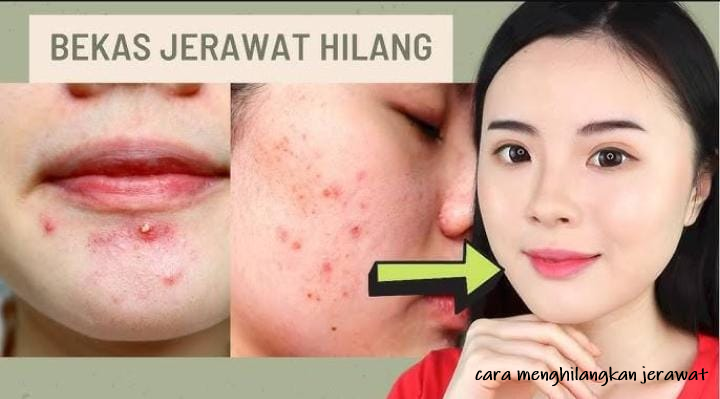cara menghilangkan jerawat