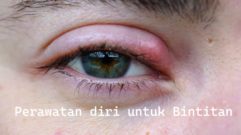perawatan diri untuk bintitan