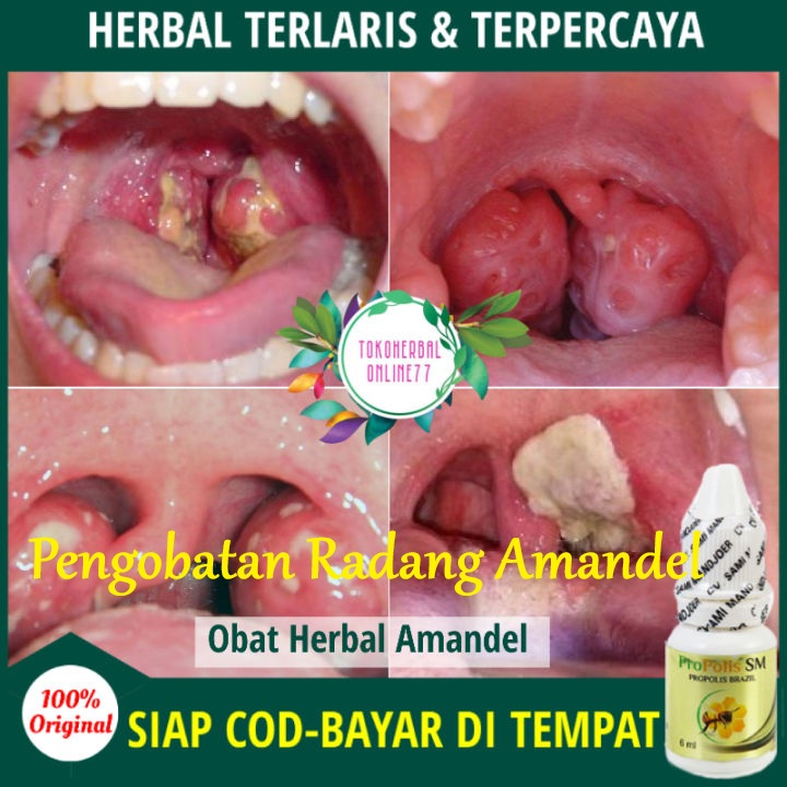 pengobatan radang amandel