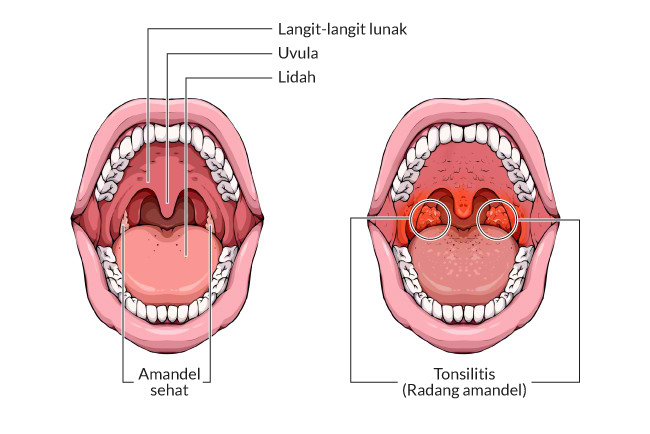 perawatan sakit tenggorokan